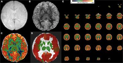 Application of pseudocontinuous arterial spin labeling perfusion imaging in children with autism spectrum disorders